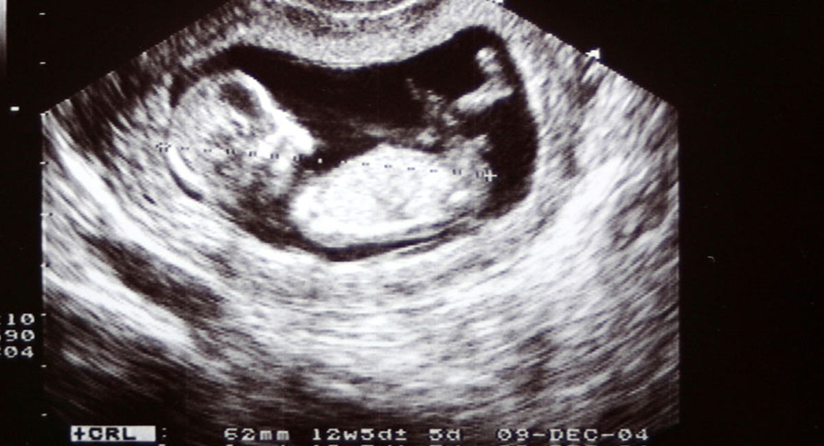 تفاوت جنین دختر و پسر در سونوگرافی هفته 12