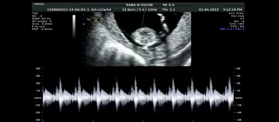 چگونه نتایج hCG می تواند به تفسیر سونوگرافی بارداری کمک کند؟ 