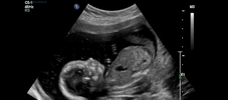 Measurement factors in ultrasound to determine the exact health and age of the fetus