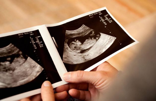 تفاوت جنین دختر و پسر در سونوگرافی هفته 12 در چیست؟ + عکس